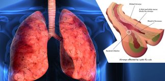 A key step toward improving and lengthening the lives of cystic fibrosis patients