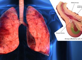 A key step toward improving and lengthening the lives of cystic fibrosis patients