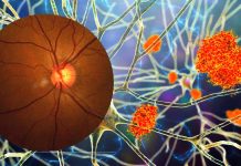 People with a normal-tension glaucoma are at high risk for developing Alzheimer’s disease