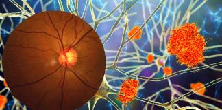 People with a normal-tension glaucoma are at high risk for developing Alzheimer’s disease