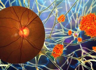 People with a normal-tension glaucoma are at high risk for developing Alzheimer’s disease