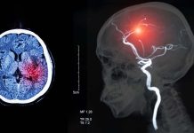 Patients with acute ischemic stroke and COVID-19 showed higher rates of intracranial bleeding complications