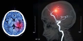 Patients with acute ischemic stroke and COVID-19 showed higher rates of intracranial bleeding complications
