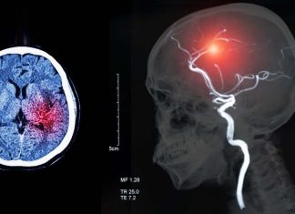 Patients with acute ischemic stroke and COVID-19 showed higher rates of intracranial bleeding complications