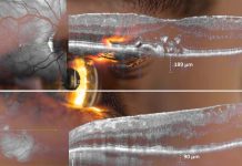 AI-enabled eye scans could be used to rapidly predict whether a person is at high risk of heart disease