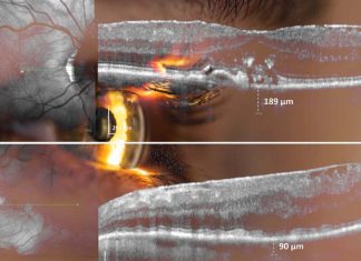 AI-enabled eye scans could be used to rapidly predict whether a person is at high risk of heart disease