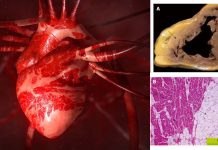 Defective Desmosomal Adhesion Causes Arrhythmogenic Cardiomyopathy