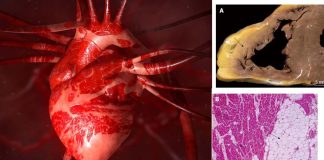 Defective Desmosomal Adhesion Causes Arrhythmogenic Cardiomyopathy