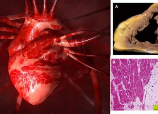 Defective Desmosomal Adhesion Causes Arrhythmogenic Cardiomyopathy