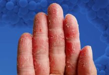 Atopic dermatitis: Rocatinlimab – novel patient-tailored monoclonal antibody therapy