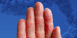 Atopic dermatitis: Rocatinlimab – novel patient-tailored monoclonal antibody therapy
