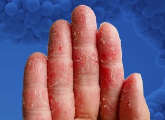 Atopic dermatitis: Rocatinlimab – novel patient-tailored monoclonal antibody therapy