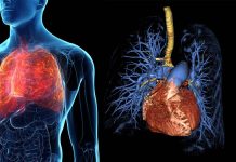 Pulmonary arterial hypertension is incurable but an experimental drug called SRT2104 may be effective