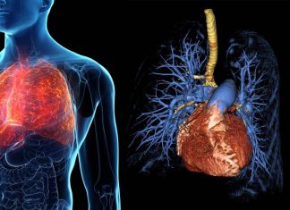 Pulmonary arterial hypertension is incurable but an experimental drug called SRT2104 may be effective