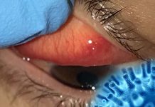 SARS-CoV-2 mostra tropismo oculare ed è in grado di causare problemi alla vista