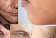 The presence of a facial scar did not have a significant impact on attractiveness