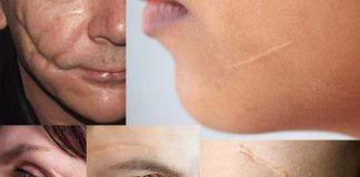 The presence of a facial scar did not have a significant impact on attractiveness