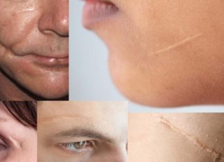 The presence of a facial scar did not have a significant impact on attractiveness