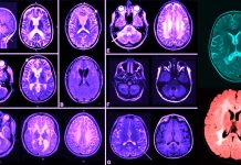 Riluzole: New Drug to treat ALS in part correct the molecular cause of some leukodystrophies