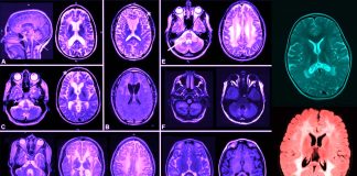 Riluzole: New Drug to treat ALS in part correct the molecular cause of some leukodystrophies