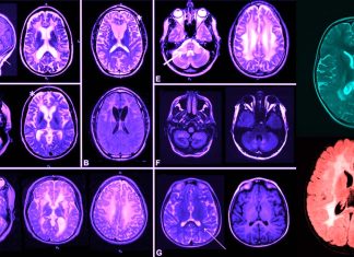 Riluzole: New Drug to treat ALS in part correct the molecular cause of some leukodystrophies