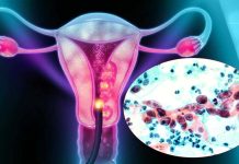 More Women Aged 65 And Above Are Dying From Cervical Cancer