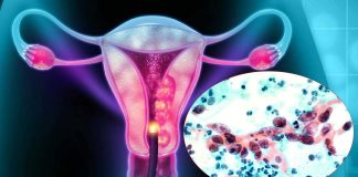 More Women Aged 65 And Above Are Dying From Cervical Cancer