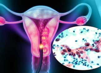 More Women Aged 65 And Above Are Dying From Cervical Cancer