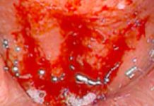 Japanese Researchers Find Cure For Post-COVID Chronic Coughs Associated with Chronic Epipharyngitis Using Zinc Chloride