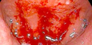 Japanese Researchers Find Cure For Post-COVID Chronic Coughs Associated with Chronic Epipharyngitis Using Zinc Chloride