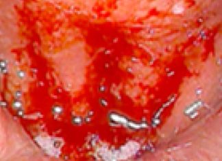 Japanese Researchers Find Cure For Post-COVID Chronic Coughs Associated with Chronic Epipharyngitis Using Zinc Chloride