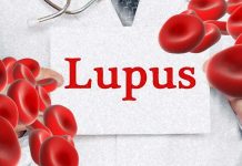 Targeting iron metabolism in immune system cells may offer a new approach for treating systemic lupus erythematosus (SLE)