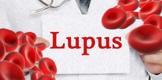 Targeting iron metabolism in immune system cells may offer a new approach for treating systemic lupus erythematosus (SLE)