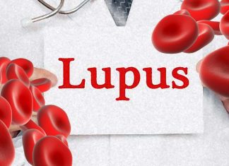 Targeting iron metabolism in immune system cells may offer a new approach for treating systemic lupus erythematosus (SLE)