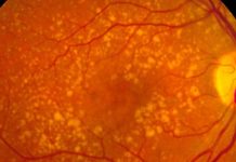 Associazione tra infezione da SARS-cov-2 e sviluppo della degenerazione maculare legata all’età (AMD)