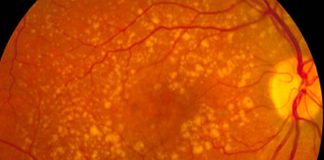Association between SARS-cov-2 infection and development of Age-related macular degeneration (AMD)