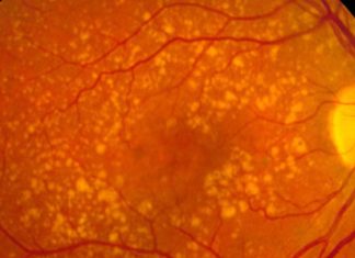 Associazione tra infezione da SARS-cov-2 e sviluppo della degenerazione maculare legata all’età (AMD)