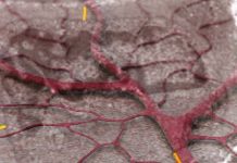 Post-COVID syndrome is associated with capillary alterations