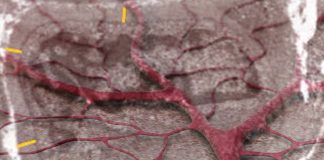 Post-COVID syndrome is associated with capillary alterations