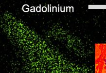 Nanoparticles of gadolinium rare earth metal used in MRI contrast agents can infiltrate kidney tissue