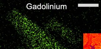 Nanoparticles of gadolinium rare earth metal used in MRI contrast agents can infiltrate kidney tissue