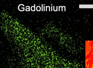 Nanoparticles of gadolinium rare earth metal used in MRI contrast agents can infiltrate kidney tissue
