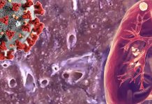 Researchers found a three-fold increase in the incidence of detecting pulmonary tuberculosis (PTB) in patients hospitalised with COVID-19 pneumonia