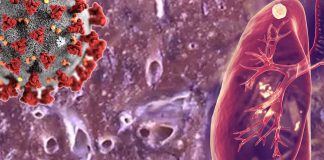Researchers found a three-fold increase in the incidence of detecting pulmonary tuberculosis (PTB) in patients hospitalised with COVID-19 pneumonia