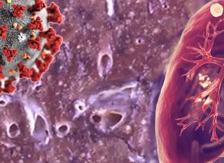 Researchers found a three-fold increase in the incidence of detecting pulmonary tuberculosis (PTB) in patients hospitalised with COVID-19 pneumonia