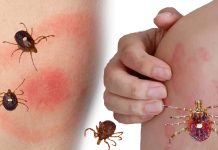Growing concern about the increase in cases of Alpha-gal syndrome