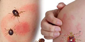 Growing concern about the increase in cases of Alpha-gal syndrome