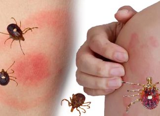 Growing concern about the increase in cases of Alpha-gal syndrome
