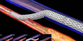 Transcatheter arterialization of the deep veins (TARDV) is a novel approach to treating chronic limb-threatening ischemia (CLTI)