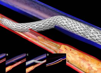 Transcatheter arterialization of the deep veins (TARDV) is a novel approach to treating chronic limb-threatening ischemia (CLTI)
